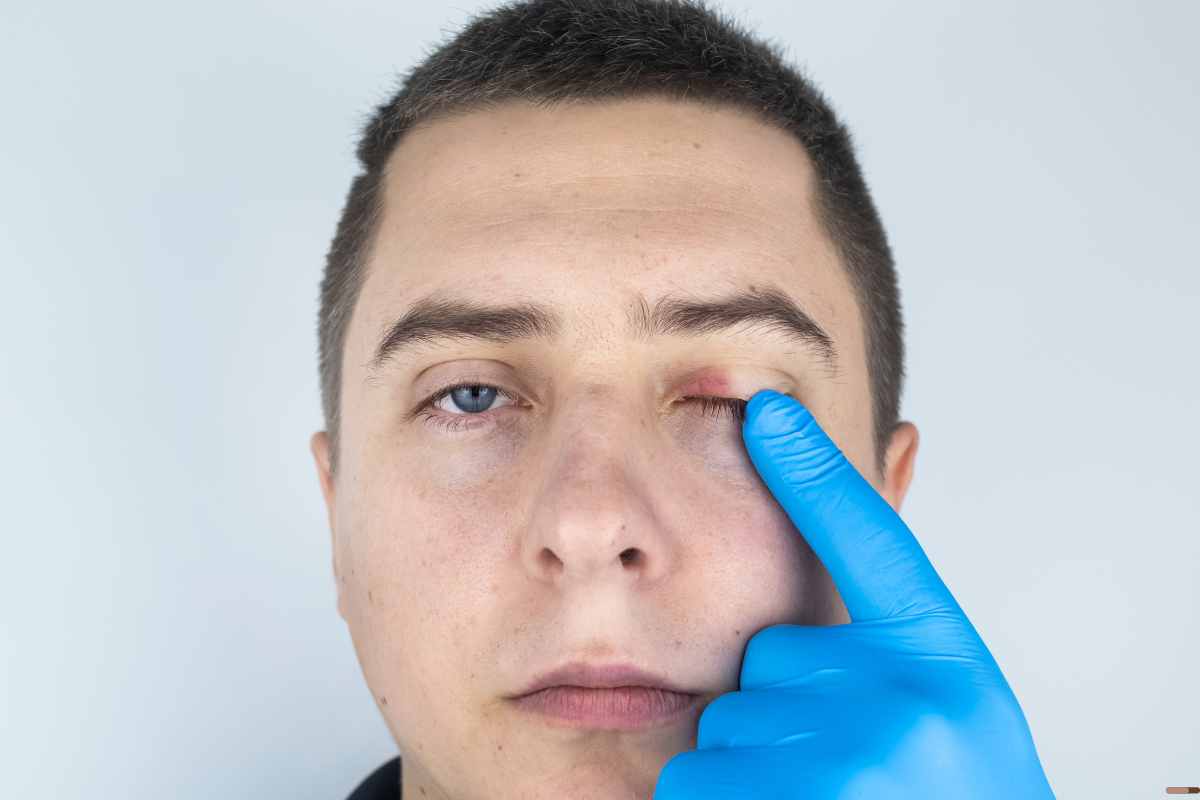 Ojos irritados La rosacea ocular podria ser la causa parpados inflamados