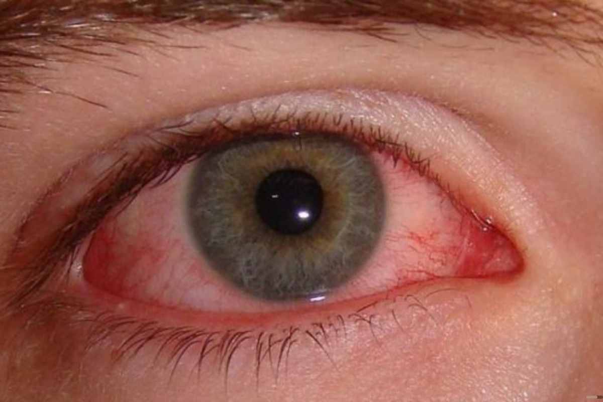 Ojos irritados La rosacea ocular podria ser la causa rosacea